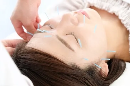 顔のむくみを解消するため美容鍼の施術を受ける女性